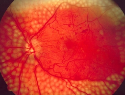 Google использует глубокое обучение для диагностики заболеваний (и весьма успешно)