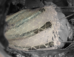 Силиконовый робот поможет сердцу биться