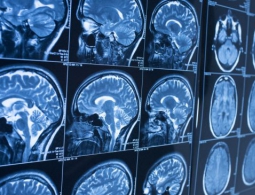 ИИ способен выявить болезнь Альцгеймера за годы до появления симптомов
