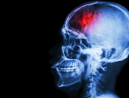 Инсульт на молекулярном уровне: что повреждается в результате удара