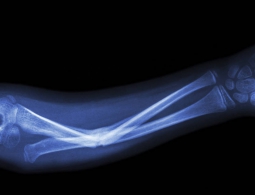 В Сиднее разработали срастающиеся с костями керамические импланты