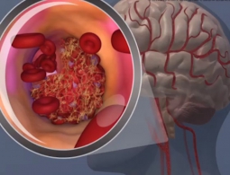 Обнаружен белок, способный защитить мозг от последствий инсульта