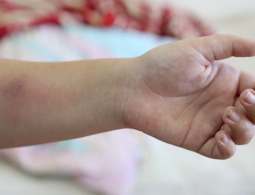 Кузнецова предложила разрешить родителям отказываться от пробы Манту