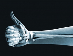 Российские ученые испытали костные имплантаты из сверхвысокомолекулярного полиэтилена