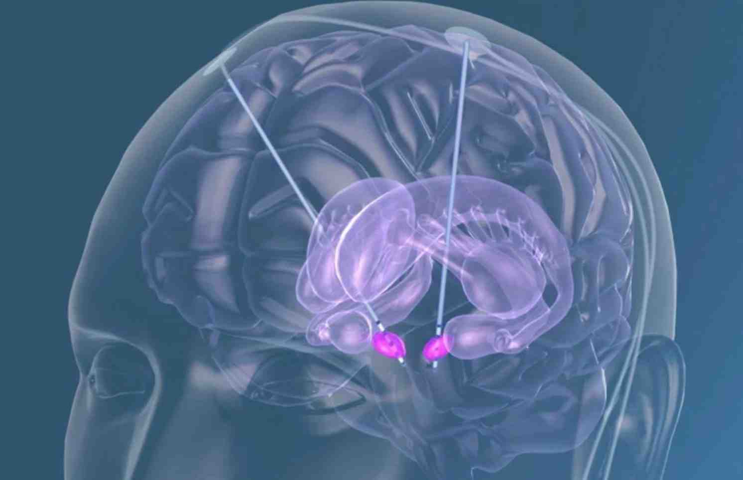 Ученые впервые восстановили память при болезни Альцгеймера