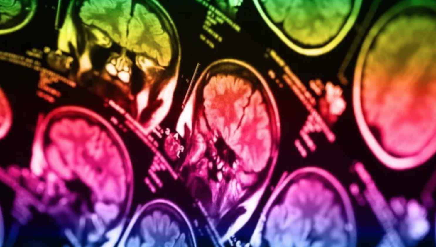 Склонность к суициду можно выявить при помощи сканирования мозга