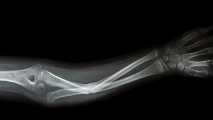 Графен обещает быстрее восстановить сломанные кости и даже предотвратить перелом